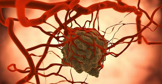 Examenele RMN releva ca celulele canceroase se dezvolta in conditii favorabile in prezenta zaharului