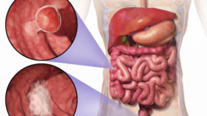 5 simptome comune in cancerul colorectal