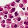 Semne de alarmă care anunță leucemia. Mare atenţie la aceste simptome!