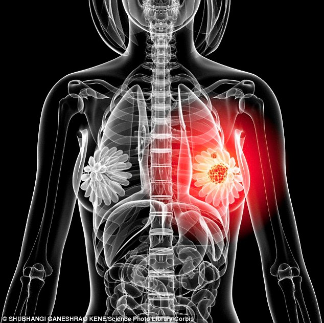 Coordonator Oncologie CNAS: Sunt 7.000 de cazuri noi de cancer mamar