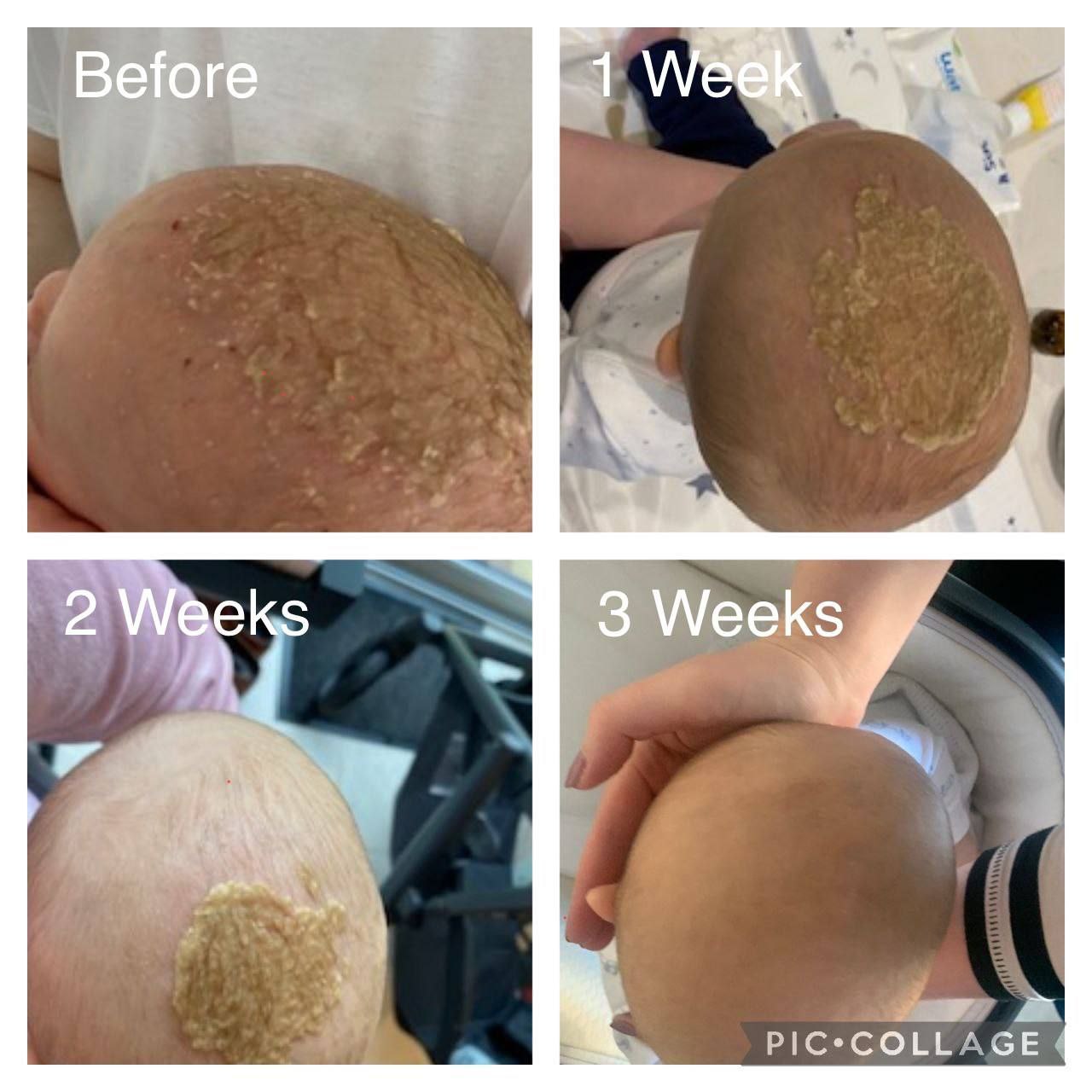MĂRTURIE: Dermatită seboreică severă la nou născut vindecată cu CDS