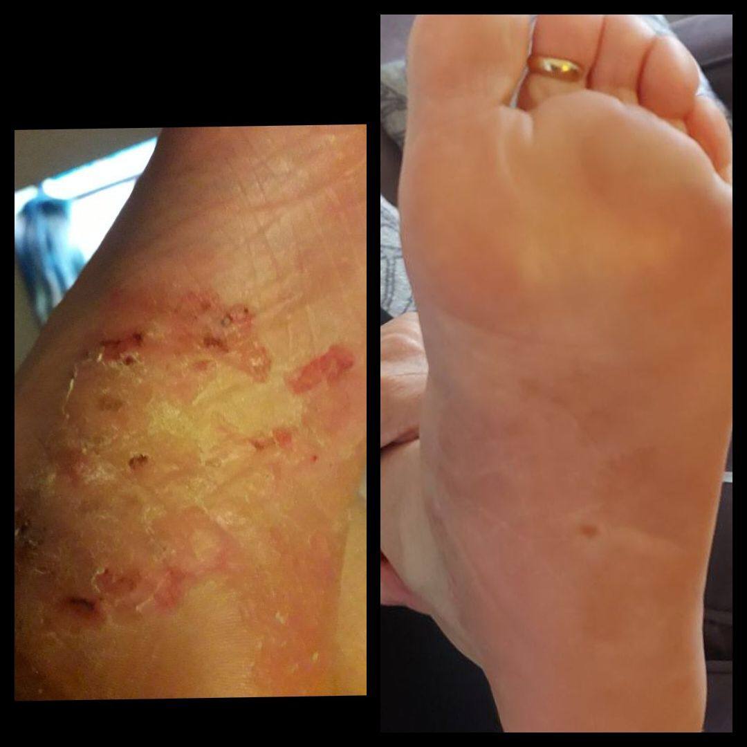 MĂRTURIE: Psoriazis plantar timp de 20 de ani, s-a vindecat in 10 zile cu CDS