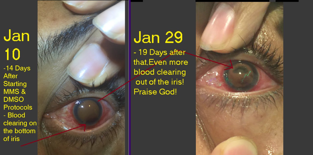 Marturie retinopatie diabetica