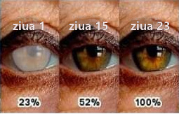 Protocol ocular cu CDS si DMSO