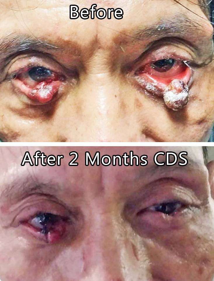 Tumorile oculare sunt eliminate cu antidotul universal (dioxid de clor)