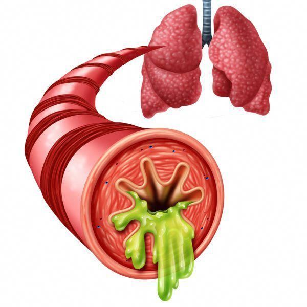 10 remedii naturale ca sa elimini mucusul din plamani si sa nu mai suni la medic